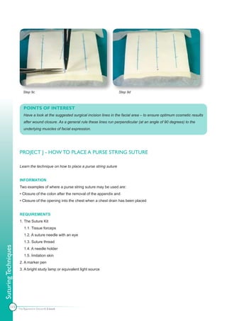 Step 9c                                                   Step 9d



                          POINTS OF INTEREST
                          Have a look at the suggested surgical incision lines in the facial area – to ensure optimum cosmetic results
                          after wound closure. As a general rule these lines run perpendicular (at an angle of 90 degrees) to the
                          underlying muscles of facial expression.




                      PROJECT J - HOW TO PLACE A PURSE STRING SUTURE

                      Learn the technique on how to place a purse string suture


                      INFORMATION
                      Two examples of where a purse string suture may be used are:
                      • Closure of the colon after the removal of the appendix and
                      • Closure of the opening into the chest when a chest drain has been placed


                      REQUIREMENTS
                      1. The Suture Kit
                          1.1. Tissue forceps
                          1.2. A suture needle with an eye
                          1.3. Suture thread
Suturing Techniques




                          1.4. A needle holder
                          1.5. Imitation skin
                      2. A marker pen
                      3. A bright study lamp or equivalent light source




            115       The Apprentice Doctor® E-book
 
