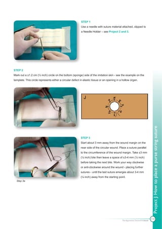 STEP 1
                                                          Use a needle with suture material attached, clipped to
                                                          a Needle Holder – see Project 2 and 3.




STEP 2
Mark out a ±1.2 cm (½ inch) circle on the bottom (sponge) side of the imitation skin - see the example on the
template. This circle represents either a circular defect in elastic tissue or an opening in a hollow organ.




                                                                                                                               Project J: How to place a purse string suture
                                                          STEP 3
                                                          Start about 3 mm away from the wound margin on the
                                                          near side of the circular wound. Place a suture parallel
                                                          to the circumference of the wound margin. Take ±3 mm
                                                          (⅛ inch) bite then leave a space of ±3-4 mm (⅛ inch)
                                                          before taking the next bite. Work your way clockwise
                                                          or anti-clockwise around the wound - placing further
                                                          sutures - until the last suture emerges about 3-4 mm
                                                          (⅛ inch) away from the starting point.
  Step 3a




                                                                                                                              116
                                                                                              The Apprentice Doctor® E-book
 