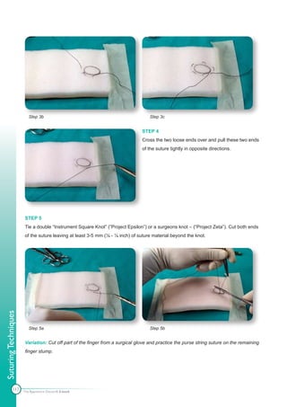 Step 3b                                                  Step 3c


                                                                              STEP 4
                                                                              Cross the two loose ends over and pull these two ends
                                                                              of the suture tightly in opposite directions.




                      STEP 5
                      Tie a double “Instrument Square Knot” (“Project Epsilon”) or a surgeons knot – (“Project Zeta”). Cut both ends
                      of the suture leaving at least 3-5 mm (⅛ - ¼ inch) of suture material beyond the knot.
Suturing Techniques




                         Step 5a                                                  Step 5b


                      Variation: Cut off part of the finger from a surgical glove and practice the purse string suture on the remaining
                      finger stump.




            117       The Apprentice Doctor® E-book
 