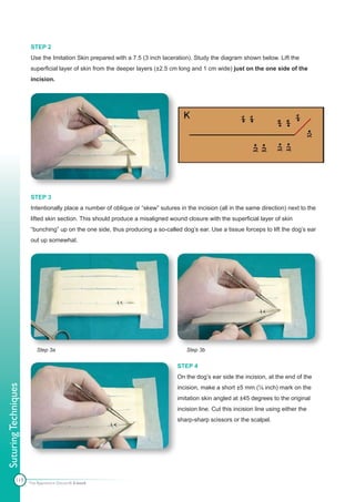 STEP 2
                      Use the Imitation Skin prepared with a 7.5 (3 inch laceration). Study the diagram shown below. Lift the
                      superficial layer of skin from the deeper layers (±2.5 cm long and 1 cm wide) just on the one side of the
                      incision.




                      STEP 3
                      Intentionally place a number of oblique or “skew” sutures in the incision (all in the same direction) next to the
                      lifted skin section. This should produce a misaligned wound closure with the superficial layer of skin
                      “bunching” up on the one side, thus producing a so-called dog’s ear. Use a tissue forceps to lift the dog’s ear
                      out up somewhat.




                          Step 3a                                                  Step 3b


                                                                                STEP 4
                                                                                On the dog’s ear side the incision, at the end of the
Suturing Techniques




                                                                                incision, make a short ±5 mm (¼ inch) mark on the
                                                                                imitation skin angled at ±45 degrees to the original
                                                                                incision line. Cut this incision line using either the
                                                                                sharp-sharp scissors or the scalpel.




            119       The Apprentice Doctor® E-book
 
