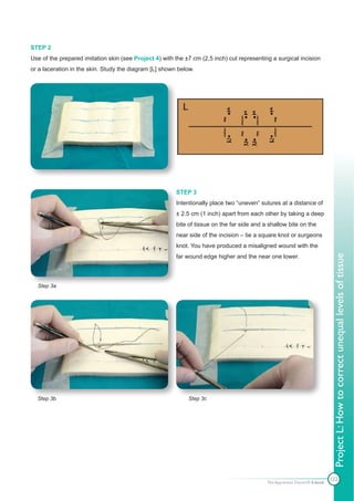 STEP 2
Use of the prepared imitation skin (see Project 4) with the ±7 cm (2,5 inch) cut representing a surgical incision
or a laceration in the skin. Study the diagram [L] shown below.




                                                        STEP 3
                                                        Intentionally place two “uneven” sutures at a distance of
                                                        ± 2.5 cm (1 inch) apart from each other by taking a deep
                                                        bite of tissue on the far side and a shallow bite on the
                                                        near side of the incision – tie a square knot or surgeons
                                                        knot. You have produced a misaligned wound with the
                                                        far wound edge higher and the near one lower.




                                                                                                                             Project L: How to correct unequal levels of tissue
  Step 3a




  Step 3b                                                    Step 3c




                                                                                                                            122
                                                                                            The Apprentice Doctor® E-book
 
