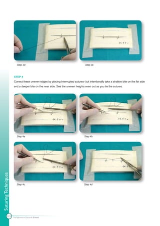 Step 3d                                                 Step 3e



                      STEP 4
                      Correct these uneven edges by placing Interrupted sutures- but intentionally take a shallow bite on the far side
                      and a deeper bite on the near side. See the uneven heights even out as you tie the sutures.




                          Step 4a                                                 Step 4b
Suturing Techniques




                          Step 4c                                                 Step 4d




            123       The Apprentice Doctor® E-book
 