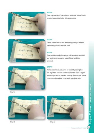 STEP 4
          Ease the one leg of the scissors within the suture loop –
          remaining as close to the skin as possible.




          STEP 5
          Gently cut the stitch, and remove by pulling it out with
          the forceps holding onto the knot.



          STEP 6
          Give another quick wipe with a mild antiseptic solution
          and apply a conservative wipe of local antibiotic
          ointment.


          STEP 7
          Remove continuous sutures by carefully easing the
          one leg of the scissors under each of the loops – again
          remain right next to the skin surface. Remove the suture
          loops by pulling all the loose ends out of the skin.




Step 7a
                                                                                Project M: How to remove sutures




Step 7b        Step 7c


                                                                               126
                                               The Apprentice Doctor® E-book
 