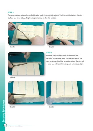STEP 8
                       Remove mattress sutures by gently lifting the knot – then cut both sides of the knot-loop just above the skin
                       surface and remove by pulling the loop remaining on the skin surface.




                          Step 8a                                                  Step 8b



                                                                               STEP 9
                                                                               Remove subcuticular sutures by removing the 2
                                                                               securing straps at the ends, cut one end next to the
                                                                               skin surface and pull the remaining suture filament out
                                                                               – away and in line with the long axis of the laceration.




                          Step 9a
Suturing Techniques




                          Step 9b                                                 Step 9c




            127
                      The Apprentice Doctor® E-book
 