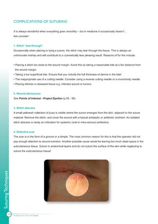 COMPLICATIONS OF SUTURING

                      It is always wonderful when everything goes smoothly – but in medicine it occasionally doesn’t…
                      lets consider:


                      1. Stitch “tear-through”
                      Occasionally when placing or tying a suture, the stitch may tear through the tissue. This is always an
                      unfortunate mishap and will contribute to a cosmetically less pleasing result. Reasons of for this include:


                      • Placing a stitch too close to the wound margin. Avoid this by taking a reasonable bite at a fair distance from
                        the wound margin.
                      • Taking a too superficial bite. Ensure that you include the full thickness of dermis in the bite!
                      • The inappropriate use of a cutting needle. Consider using a reverse cutting needle or a round-body needle.
                      • Placing stitches in diseased tissue e.g. infected wound or tumors.


                      2. Wound dehiscence
                      See Points of Interest - Project Epsilon (p.55 - 56)


                      3. Stitch abscess
                      A small yellowish collection of puss is visible where the suture emerges from the skin, adjacent to the suture
                      material. Remove the stitch, and cover the wound with a topical antiseptic or antibiotic ointment. An isolated
                      stitch abscess is rarely an indication for systemic (oral or intra-venous) antibiotics.


                      4. Defective scar
                      The scar is in the form of a groove or a dimple. The most common reason for this is that the operator did not
                      pay enough attention to wound eversion. Another possible cause would be leaving too much dead space in the
                      subcutaneous tissue. Suture in anatomical layers and do not suture the surface of the skin while neglecting to
                      suture the subcutaneous tissue!
Suturing Techniques




            129       The Apprentice Doctor® E-book
 