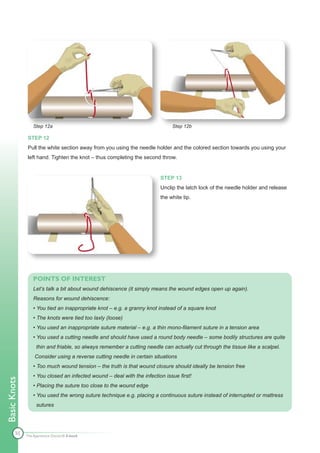 Step 12a                                                    Step 12b

              STEP 12
              Pull the white section away from you using the needle holder and the colored section towards you using your
              left hand. Tighten the knot – thus completing the second throw.


                                                                         STEP 13
                                                                         Unclip the latch lock of the needle holder and release
                                                                         the white tip.




                  POINTS OF INTEREST
                  Let’s talk a bit about wound dehiscence (it simply means the wound edges open up again).
                  Reasons for wound dehiscence:
                  • You tied an inappropriate knot – e.g. a granny knot instead of a square knot
                  • The knots were tied too laxly (loose)
                  • You used an inappropriate suture material – e.g. a thin mono-filament suture in a tension area
                  • You used a cutting needle and should have used a round body needle – some bodily structures are quite
                   thin and friable, so always remember a cutting needle can actually cut through the tissue like a scalpel.
                  Consider using a reverse cutting needle in certain situations
                  • Too much wound tension – the truth is that wound closure should ideally be tension free
                  • You closed an infected wound – deal with the infection issue first!
Basic Knots




                  • Placing the suture too close to the wound edge
                  • You used the wrong suture technique e.g. placing a continuous suture instead of interrupted or mattress
                   sutures




        55    The Apprentice Doctor® E-book
 