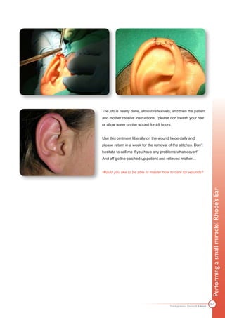 The job is neatly done, almost reflexively, and then the patient
and mother receive instructions, “please don’t wash your hair
or allow water on the wound for 48 hours.


Use this ointment liberally on the wound twice daily and
please return in a week for the removal of the stitches. Don’t
hesitate to call me if you have any problems whatsoever!”
And off go the patched-up patient and relieved mother…


Would you like to be able to master how to care for wounds?




                                                                         Performing a small miracle! Rhodé’s Ear




                                                                         62
                                         The Apprentice Doctor® E-book
 