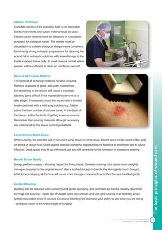 Aseptic Technique
Complete sterility of the operative field is not attainable.
Sterile instruments and suture material must be used.
Excess suture material must be discarded in a container
purposed for biological waste. The needle must be
discarded in a suitable biological sharps waste container).
Avoid using strong antiseptic preparations for cleaning the
wound. Most antiseptic solutions will cause damage to the
friable exposed tissue cells. In most cases a normal saline
solution will be sufficient to clean an uninfected wound!


Remove All Foreign Material
The removal of all foreign material must be ensured.
Remove all pieces of glass, soil, plant material etc.
Soil remaining in the wound will cause a traumatic
tattooing (very difficult if not impossible to remove at a
later stage!) If necessary brush the wound with a bristled
brush combined with a mild soap solution e.g. Savlon.
Leave the least number of sutures buried in the depth of
the tissue - within the limits of getting a secure closure.
Remember that suturing materials although necessary
are considered by the tissue as foreign material.


Leave Minimal Dead Space
While suturing, the operator will try to suture living tissue to living tissue. Do not leave empty spaces filled with
air, blood or tissue fluid. Dead spaces produce wonderful opportunities for bacteria to proliferate and to cause



                                                                                                                                The basic principles of wound care
infection. Dead space may fill up with blood clot and will contribute to the formation of excessive scarring.


Handle Tissue Gently
Always perform surgery - showing respect for living tissue. Careless suturing may cause more unsightly
damage compared to the original wound! Use a toothed forceps to handle the skin (gently touch though).
A flat forceps slipping all the time will cause more damage compared to a toothed forceps handled gently.


Control Bleeding
Bleeding can be reduced with suctioning and gentle sponging, and controlled by Electro-cautery (electrical
burning) and suturing – ligate (tie-off) larger veins and arteries and use tight suturing over bleeding areas
(within reasonable limits of course). Excessive bleeding will decrease your ability to see what you are doing
– and good vision is the first principle of surgery!




                                                                                                                                66
                                                                                                The Apprentice Doctor® E-book
 