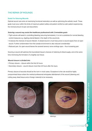 THE REPAIR OF WOUNDS

Goals For Suturing Wounds
Optimal wound care aims at maximizing functional restoration as well as optimizing the esthetic result. These
goals must occur within the limits of maximum patient safety and patient comfort (a calm patient experiencing
the minimal amount of pain and discomfort).


Suturing a wound may assist the healthcare professional with 3 immediate goals:
• Tight sutures will assist in controlling bleeding (securing hemostasis). It is not a substitute for normal bleeding
 control measures e.g. ligating arterial bleeds in the depth of the wound etc.
• It reduces the chances of wound infection. A closed wound is much less prone to wound sepsis than an open
 wound. Further contamination from the outside environment is also reduced considerably!
• Reduced pain. An open wound leaves the severed sensory nerve endings open – thus increasing pain.


Suturing a wound will optimize the traumatized tissue’s chances of retaining its blood supply, and at the same
time minimizing the formation of unsightly scar tissue.


Wound closure is divided into:
• Primary closure – closure within the first 24 hours
• Secondary closure – wound closure more than 24 hours after the injury.


Primary closure of wounds should be the norm in most cases. Exceptions to the rule would be highly
compromised tissue where the medical professional anticipates debridement of the wound (cleaning and
cutting away dead tissue and-or foreign material) to be necessary.




                                                                                                                               The basic principles of wound care




  Lesion                                                         Markings




                                                                                                                               68
                                                                                               The Apprentice Doctor® E-book
 