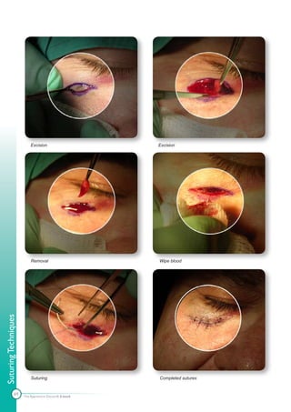 Excision                    Excision




                          Removal                     Wipe blood
Suturing Techniques




                          Suturing                    Completed sutures


              69      The Apprentice Doctor® E-book
 