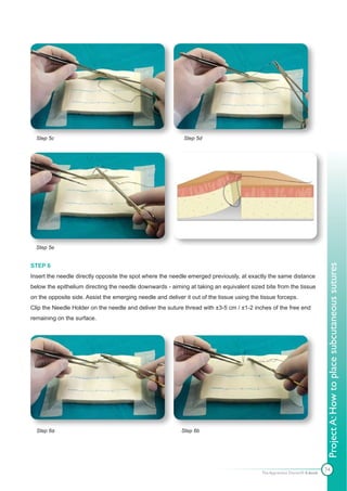 Step 5c                                                    Step 5d




  Step 5e


STEP 6




                                                                                                                            Project A: How to place subcutaneous sutures
Insert the needle directly opposite the spot where the needle emerged previously, at exactly the same distance
below the epithelium directing the needle downwards - aiming at taking an equivalent sized bite from the tissue
on the opposite side. Assist the emerging needle and deliver it out of the tissue using the tissue forceps.
Clip the Needle Holder on the needle and deliver the suture thread with ±3-5 cm / ±1-2 inches of the free end
remaining on the surface.




  Step 6a                                                   Step 6b




                                                                                                                            74
                                                                                            The Apprentice Doctor® E-book
 