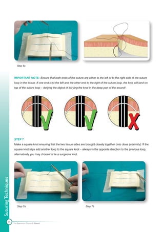 Step 6c



                      IMPORTANT NOTE: Ensure that both ends of the suture are either to the left or to the right side of the suture
                      loop in the tissue. If one end is to the left and the other end to the right of the suture loop, the knot will land on
                      top of the suture loop – defying the object of burying the knot in the deep part of the wound!




                       STEP 7
                       Make a square knot ensuring that the two tissue sides are brought closely together (into close proximity). If the
                       square knot slips add another loop to the square knot – always in the opposite direction to the previous loop,
                       alternatively you may choose to tie a surgeons knot.
Suturing Techniques




                          Step 7a                                                    Step 7b




              75      The Apprentice Doctor® E-book
 