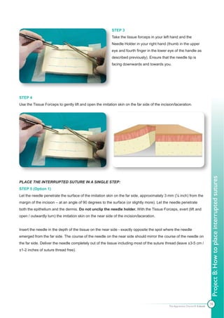 STEP 3
                                                          Take the tissue forceps in your left hand and the
                                                          Needle Holder in your right hand (thumb in the upper
                                                          eye and fourth finger in the lower eye of the handle as
                                                          described previously). Ensure that the needle tip is
                                                          facing downwards and towards you.




STEP 4
Use the Tissue Forceps to gently lift and open the imitation skin on the far side of the incision/laceration.




                                                                                                                              Project B: How to place interrupted sutures
PLACE THE INTERRUPTED SUTURE IN A SINGLE STEP:
STEP 5 (Option 1)
Let the needle penetrate the surface of the imitation skin on the far side, approximately 3 mm (⅛ inch) from the
margin of the incision – at an angle of 90 degrees to the surface (or slightly more). Let the needle penetrate
both the epithelium and the dermis. Do not unclip the needle holder. With the Tissue Forceps, evert (lift and
open / outwardly turn) the imitation skin on the near side of the incision/laceration.


Insert the needle in the depth of the tissue on the near side - exactly opposite the spot where the needle
emerged from the far side. The course of the needle on the near side should mirror the course of the needle on
the far side. Deliver the needle completely out of the tissue including most of the suture thread (leave ±3-5 cm /
±1-2 inches of suture thread free).




                                                                                                                              78
                                                                                              The Apprentice Doctor® E-book
 