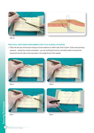 Step 5c



                      PRACTICAL HINTS WHEN PERFORMING STEP 5 IN A CLINICAL SITUATION:
                      1. Place the two tips of the tissue forceps at some distance on either side of the incision. Exert some pinching
                          pressure – raising the incision somewhat – you are everting the wound, and will be able to traverse the
                          tissue from the far side to the near side in one single thrust of the needle.




                         Step a                                                      Step b
Suturing Techniques




                         Step c                                                      Step d




               81
                      The Apprentice Doctor® E-book
 