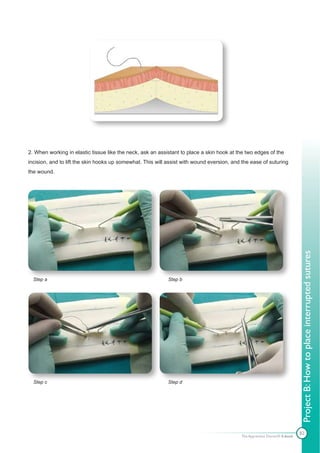 2. When working in elastic tissue like the neck, ask an assistant to place a skin hook at the two edges of the
incision, and to lift the skin hooks up somewhat. This will assist with wound eversion, and the ease of suturing
the wound.




                                                                                                                           Project B: How to place interrupted sutures
  Step a                                                    Step b




  Step c                                                    Step d




                                                                                                                           82
                                                                                           The Apprentice Doctor® E-book
 