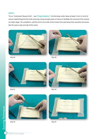 STEP 6
                       Tie an “Instrument Square Knot” – see “Project Epsilon”. Cut the loose ends; leave at least 3 mm (⅛ inch) of
                       suture material beyond the knots ensuring a long enough piece of suture to facilitate the removal of the sutures
                       at a later stage. On completion, pull the knot to one side of the incision line (pull away from sensitive structures
                       like the eyes or lips and ala of the nose).




                         Step 6a                                                    Step 6b




                         Step 6c                                                    Step 6d
Suturing Techniques




                         Step 6e                                                    Step 6f




               83     The Apprentice Doctor® E-book
 
