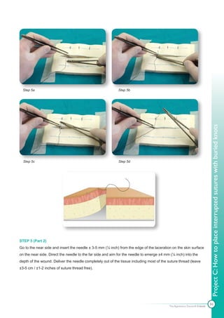 Step 5a                                                   Step 5b




                                                                                                                           Project C: How to place interrupted sutures with buried knots
  Step 5c                                                   Step 5d




STEP 5 (Part 2)
Go to the near side and insert the needle ± 3-5 mm (¼ inch) from the edge of the laceration on the skin surface
on the near side. Direct the needle to the far side and aim for the needle to emerge ±4 mm (¼ inch) into the
depth of the wound. Deliver the needle completely out of the tissue including most of the suture thread (leave
±3-5 cm / ±1-2 inches of suture thread free).




                                                                                                                           86
                                                                                           The Apprentice Doctor® E-book
 