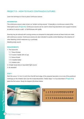 PROJECT D - HOW TO PLACE CONTINUOUS SUTURES

                      Learn the technique on how to place continuous sutures


                      INFORMATION
                      The continuous suture is also known as “simple running sutures”. It basically is a continuous variant of the
                      Interrupted suture (Project B). Continuous sutures can be used to close long lacerations and surgical incisions
                      as well as to secure a split - or full-thickness skin grafts.


                      Scarring may be reduced with running sutures as compared to interrupted sutures as fewer knots are made
                      with continuous sutures. Continuous sutures are also indicated to quickly control bleeding in the absence of
                      other bleeding control measures e.g. a profusely
                      bleeding scalp wound.


                      REQUIREMENTS
                      1. The Suture Kit
                          1.1. Tissue forceps
                          1.2. A suture needle with an eye
                          1.3. Suture thread
                          1.4. A needle holder
                          1.5. Imitation skin
                      2. A bright study lamp or equivalent light source
                      3. An assistant



                      STEP 1
                      Start the suture 1-2 mm (⅛ inch) from the left hand edge of the prepared laceration (or at one of the positional
                      markings) on the imitation skin over the incision/laceration. Follow steps 1 to 5 as described in Project B to
                      place the first suture. Study the diagram [D] shown below.
Suturing Techniques




              89      The Apprentice Doctor® E-book
 