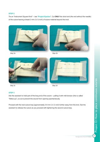 STEP 2
Tie an “Instrument Square Knot” – see “Project Epsilon”. Cut ONLY the short end (the end without the needle)
of the suture leaving at least 3 mm (¼-⅛ inch) of suture material beyond the knot.




  Step 2a                                                      Step 2b




                                                                                                                                Project D: How to place continuous sutures
  Step 2c                                                     Step 2d



STEP 3
Ask the assistant to hold part of the long end of the suture – pulling it with mild tension (this is called
“follow-up”), so as to prevent the wound from opening spontaneously.


Proceed with the next suture loop approximately 3-5 mm (¼-⅛ inch) further away from the knot. Ask the
assistant to release the suture as you proceed with tightening the second suture loop.




                                                                                                                                90
                                                                                                The Apprentice Doctor® E-book
 