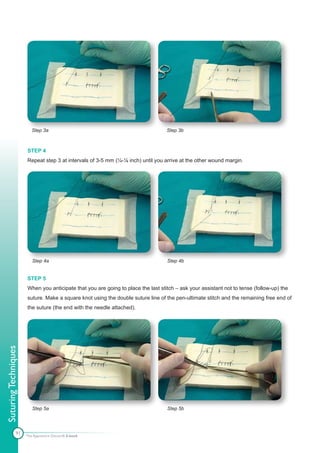 Step 3a                                                  Step 3b



                      STEP 4
                      Repeat step 3 at intervals of 3-5 mm (¼-⅛ inch) until you arrive at the other wound margin.




                         Step 4a                                                  Step 4b


                      STEP 5
                      When you anticipate that you are going to place the last stitch – ask your assistant not to tense (follow-up) the
                      suture. Make a square knot using the double suture line of the pen-ultimate stitch and the remaining free end of
                      the suture (the end with the needle attached).
Suturing Techniques




                         Step 5a                                                  Step 5b




               91
                      The Apprentice Doctor® E-book
 