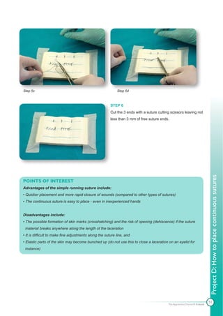 Step 5c                                                     Step 5d



                                                        STEP 6
                                                        Cut the 3 ends with a suture cutting scissors leaving not
                                                        less than 3 mm of free suture ends.




                                                                                                                           Project D: How to place continuous sutures
POINTS OF INTEREST
Advantages of the simple running suture include:
• Quicker placement and more rapid closure of wounds (compared to other types of sutures)
• The continuous suture is easy to place - even in inexperienced hands


Disadvantages include:
• The possible formation of skin marks (crosshatching) and the risk of opening (dehiscence) if the suture
 material breaks anywhere along the length of the laceration
• It is difficult to make fine adjustments along the suture line, and
• Elastic parts of the skin may become bunched up (do not use this to close a laceration on an eyelid for
 instance)




                                                                                                                           92
                                                                                           The Apprentice Doctor® E-book
 
