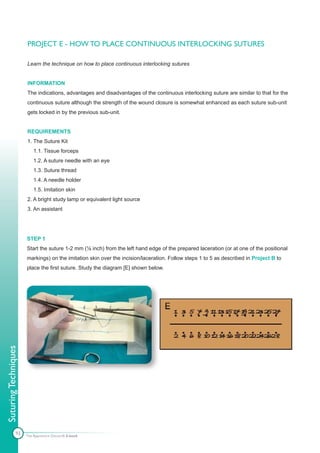 PROJECT E - HOW TO PLACE CONTINUOUS INTERLOCKING SUTURES

                      Learn the technique on how to place continuous interlocking sutures


                      INFORMATION
                      The indications, advantages and disadvantages of the continuous interlocking suture are similar to that for the
                      continuous suture although the strength of the wound closure is somewhat enhanced as each suture sub-unit
                      gets locked in by the previous sub-unit.


                      REQUIREMENTS
                      1. The Suture Kit
                          1.1. Tissue forceps
                          1.2. A suture needle with an eye
                          1.3. Suture thread
                          1.4. A needle holder
                          1.5. Imitation skin
                      2. A bright study lamp or equivalent light source
                      3. An assistant




                      STEP 1
                      Start the suture 1-2 mm (⅛ inch) from the left hand edge of the prepared laceration (or at one of the positional
                      markings) on the imitation skin over the incision/laceration. Follow steps 1 to 5 as described in Project B to
                      place the first suture. Study the diagram [E] shown below.
Suturing Techniques




               93     The Apprentice Doctor® E-book
 