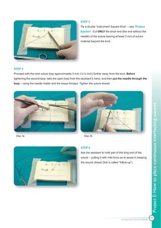 STEP 2
                                                        Tie a double “Instrument Square Knot” – see “Project
                                                        Epsilon”. Cut ONLY the short end (the end without the
                                                        needle) of the suture leaving at least 3 mm of suture
                                                        material beyond the knot.




STEP 3
Proceed with the next suture loop approximately 5 mm (¼-⅛ inch) further away from the knot. Before
tightening the second loop, take the open loop from the assistant’s hand, and then put the needle through the
loop – using the needle holder and the tissue forceps. Tighten the suture thread.




                                                                                                                            Project E: How to place continuous interlocking sutures
 Step 3a                                                  Step 3b



                                                        STEP 4
                                                        Ask the assistant to hold part of the long end of the
                                                        suture – pulling it with mild force as to assist in keeping
                                                        the wound closed (this is called “follow-up”).




                                                                                                                            94
                                                                                            The Apprentice Doctor® E-book
 