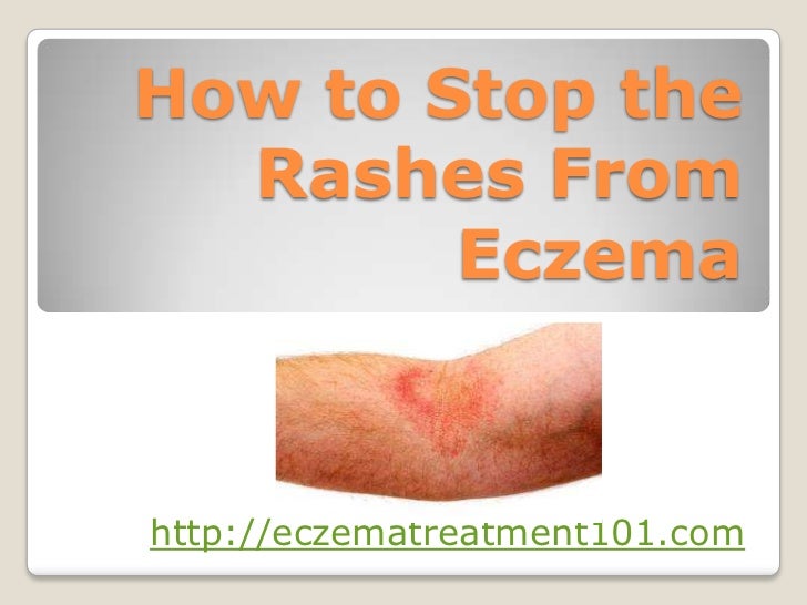 How to stop the rashes from eczema