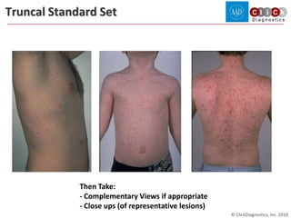Truncal Rash Area How to take Dermatology Pictures | PPTX
