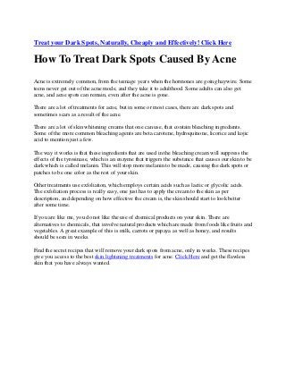 Treat your Dark Spots, Naturally, Cheaply and Effectively! Click Here
How To Treat Dark Spots Caused By Acne
Acne is extremely common, from the teenage years when the hormones are going haywire. Some
teens never get out of the acne mode, and they take it to adulthood. Some adults can also get
acne, and acne spots can remain, even after the acne is gone.
There are a lot of treatments for acne, but in some or most cases, there are dark spots and
sometimes scars as a result of the acne.
There are a lot of skin whitening creams that one can use, that contain bleaching ingredients.
Some of the more common bleaching agents are beta carotene, hydroquinone, licorice and kojic
acid to mention just a few.
The way it works is that these ingredients that are used in the bleaching cream will suppress the
effects of the tyrosinase, which is an enzyme that triggers the substance that causes our skin to be
dark which is called melanin. This will stop more melanin to be made, causing the dark spots or
patches to be one color as the rest of your skin.
Other treatments use exfoliation, which employs certain acids such as lactic or glycolic acids.
The exfoliation process is really easy, one just has to apply the cream to the skin as per
description, and depending on how effective the cream is, the skin should start to look better
after some time.
If you are like me, you do not like the use of chemical products on your skin. There are
alternatives to chemicals, that involve natural products which are made from foods like fruits and
vegetables. A great example of this is milk, carrots or papaya as well as honey, and results
should be seen in weeks.
Find the secret recipes that will remove your dark spots from acne, only in weeks. These recipes
give you access to the best skin lightening treatments for acne. Click Here and get the flawless
skin that you have always wanted.
 