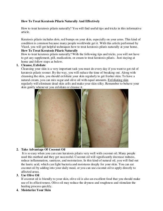 how to treat keratosis pilaris alba how to treat keratosis pilaris alba