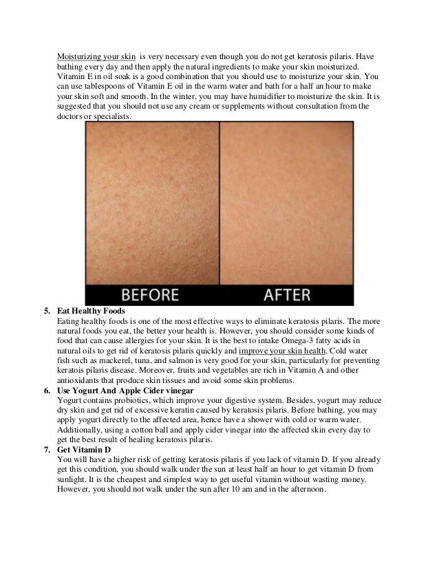How To Treat Keratosis Pilaris Naturally And Effectively