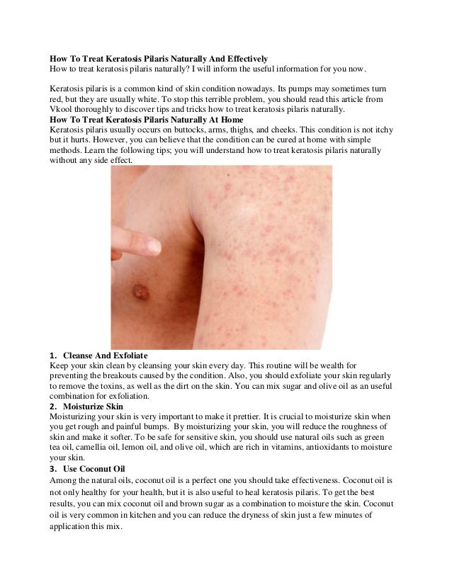 How To Treat Keratosis Pilaris Naturally How To Treat Keratosis Pilaris Naturally