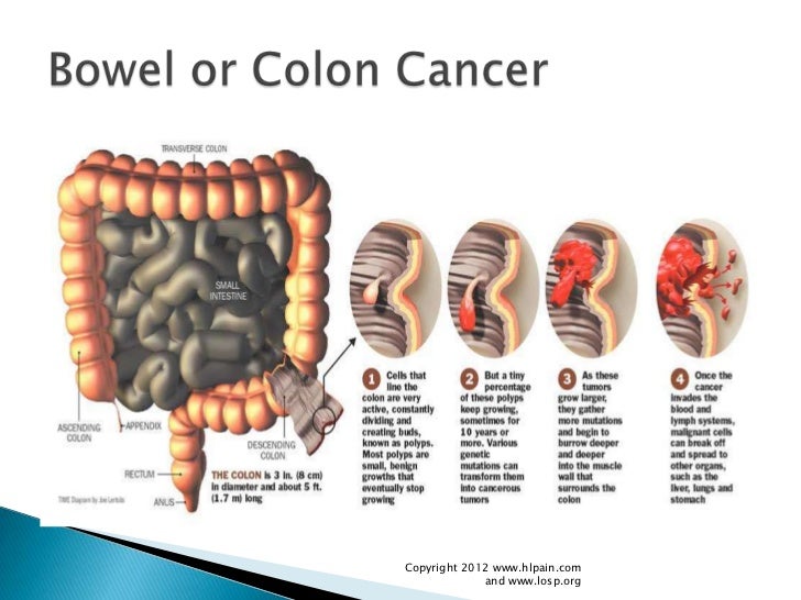 colon-cancer-as-related-to-abdominal-pain-pictures