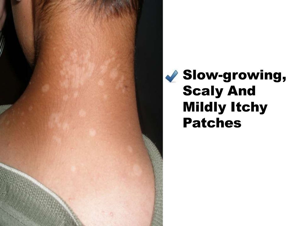 How To Treat Tinea Versicolor