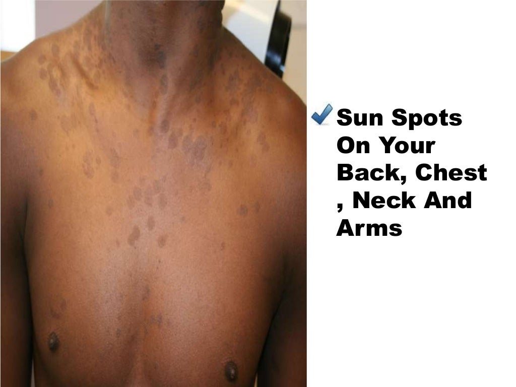 How To Treat Tinea Versicolor