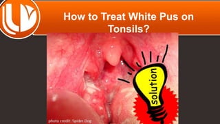 How to Treat White Pus on 
Tonsils? 
 