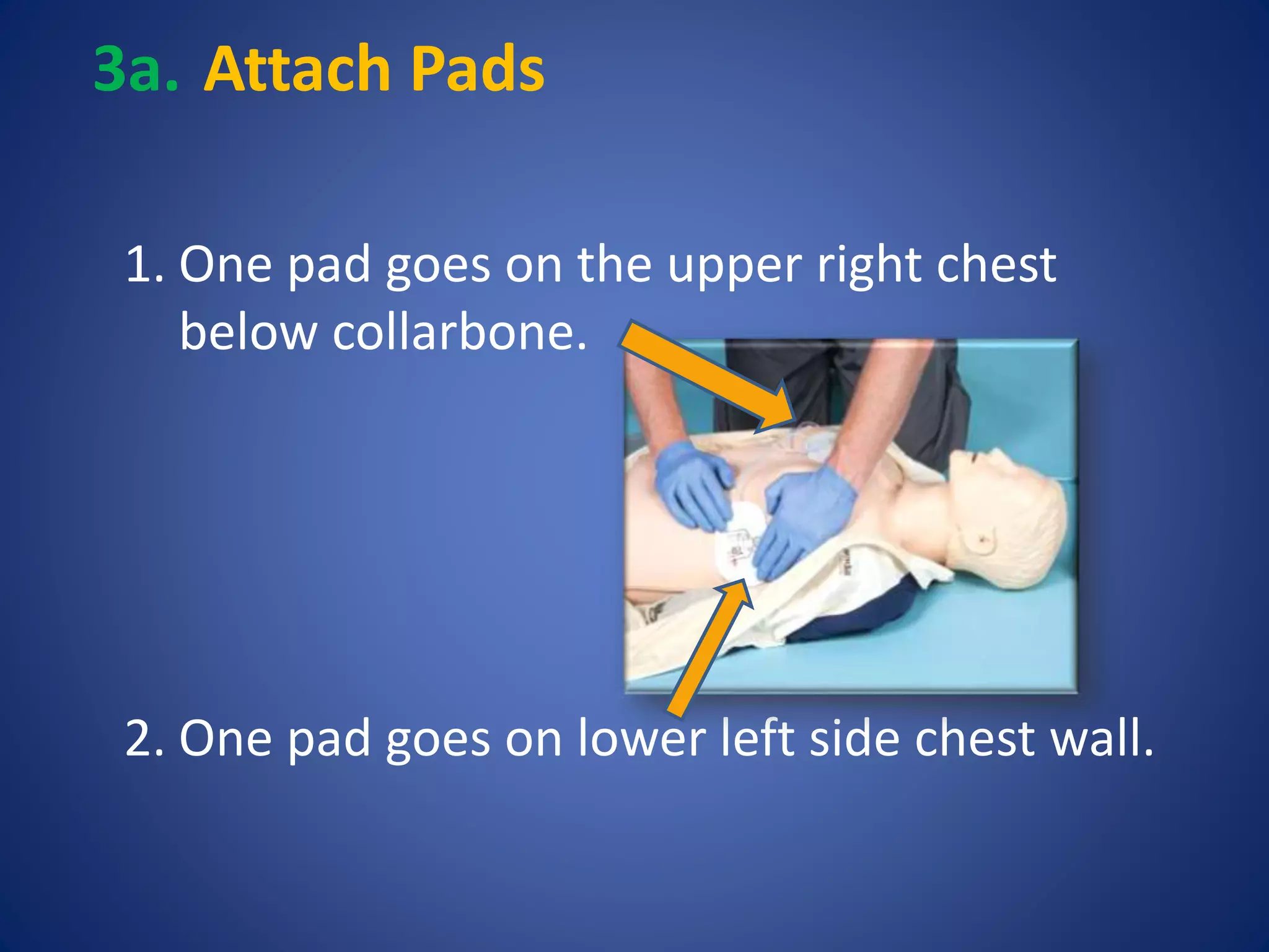 3a. Attach Pads 
1. One pad goes on the upper right chest 
below collarbone. 
2. One pad goes on lower left side chest wall. 
 