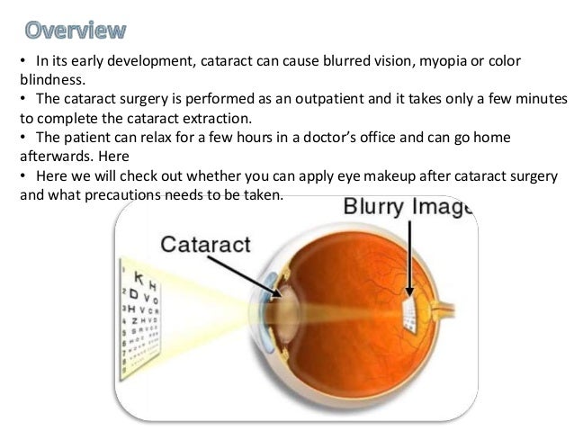 How to put on eye makeup after cararact surgery How to put on eye makeup after cararact surgery