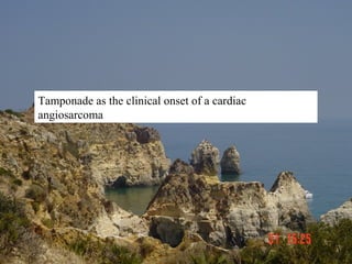 Tamponade as the clinical onset of a cardiac
angiosarcoma
 
