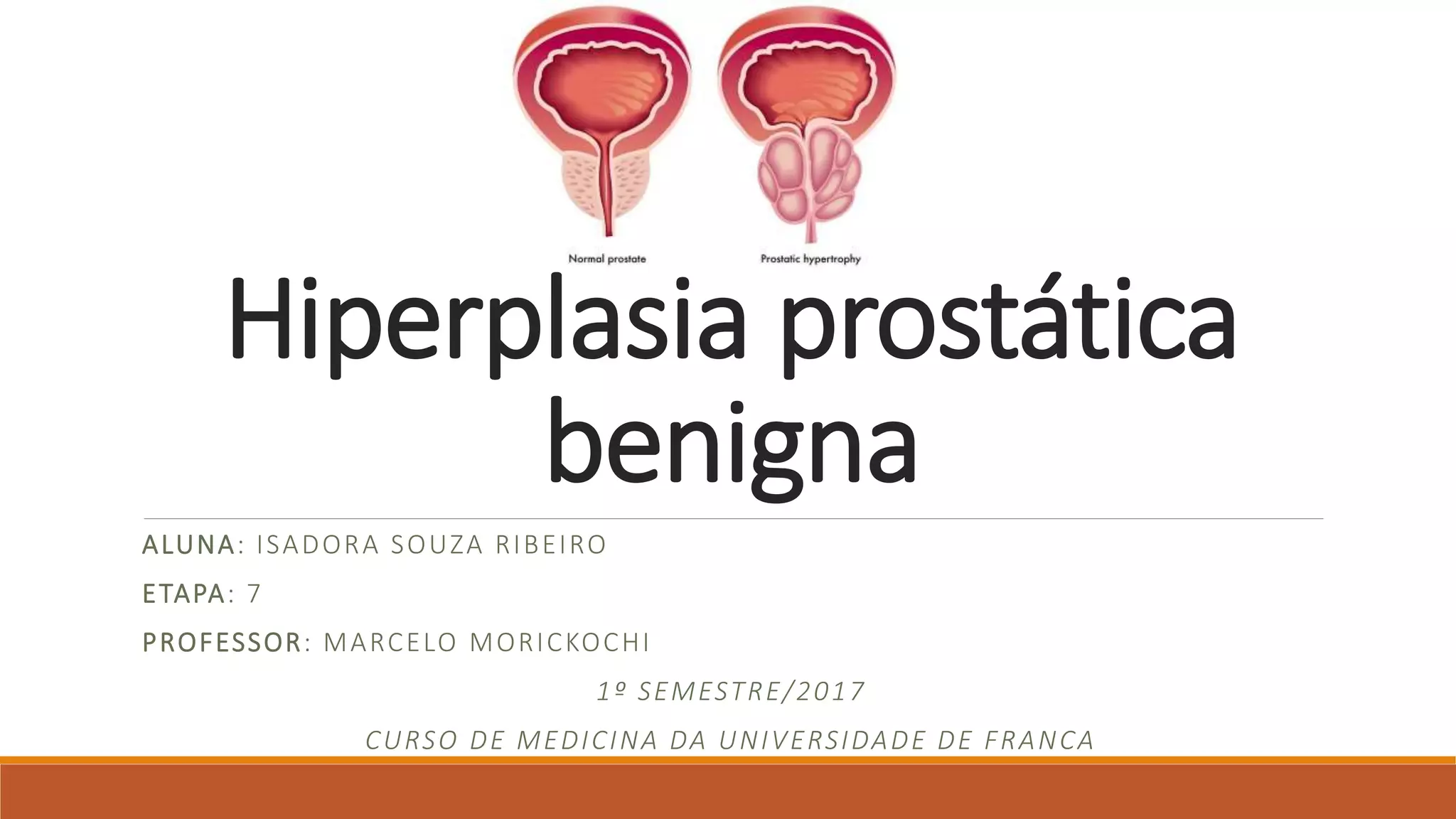 Hiperplasia prostática benigna | PPTX