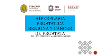 HIPERPLASIA
PROSTATICA
BENIGNA Y CANCER
DE PROSTATA
DR. LEVI AMISADID MARQUEZ SANCHEZ
 