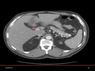 IMAGING IN HEPATOPANCREATICOBILIARY TUMORS - A GUIDE TO RT PLANNING | PPTX