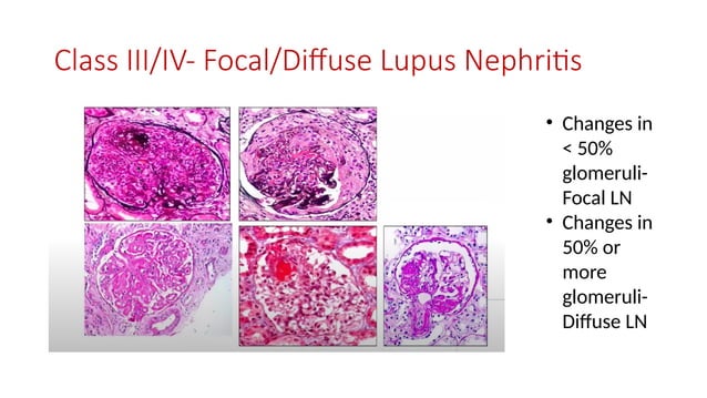 histopathology of classes of lupus nephritis | PPTX