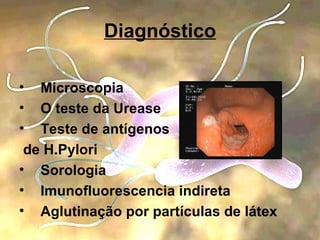 Diagnóstico Microscopia O teste da Urease Teste de antígenos de H.Pylori Sorologia Imunofluorescencia indireta Aglutinação por partículas de látex 