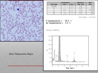 Beta Thalassemia Major
 