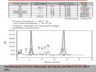 Chromatogram of E beta thalassemia showing elevated HbA2 51.4%, Hb F
30%.
 