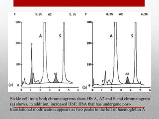 Sickle cell trait; both chromatograms show Hb A, A2 and S and chromatogram
(a) shows, in addition, increased HbF; HbA that has undergone post-
translational modification appears as two peaks to the left of haemoglobin A
 