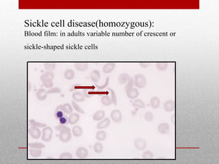 Sickle cell disease(homozygous):
Blood film: in adults variable number of crescent or
sickle-shaped sickle cells
 