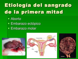 Etiología del sangrado de la primera mitad Aborto Embarazo ectópico Embarazo molar 